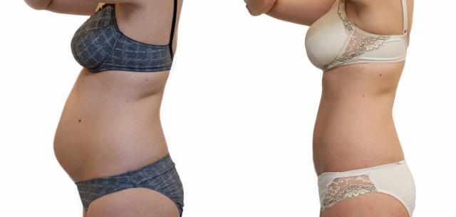 Liposukce břicha před a po